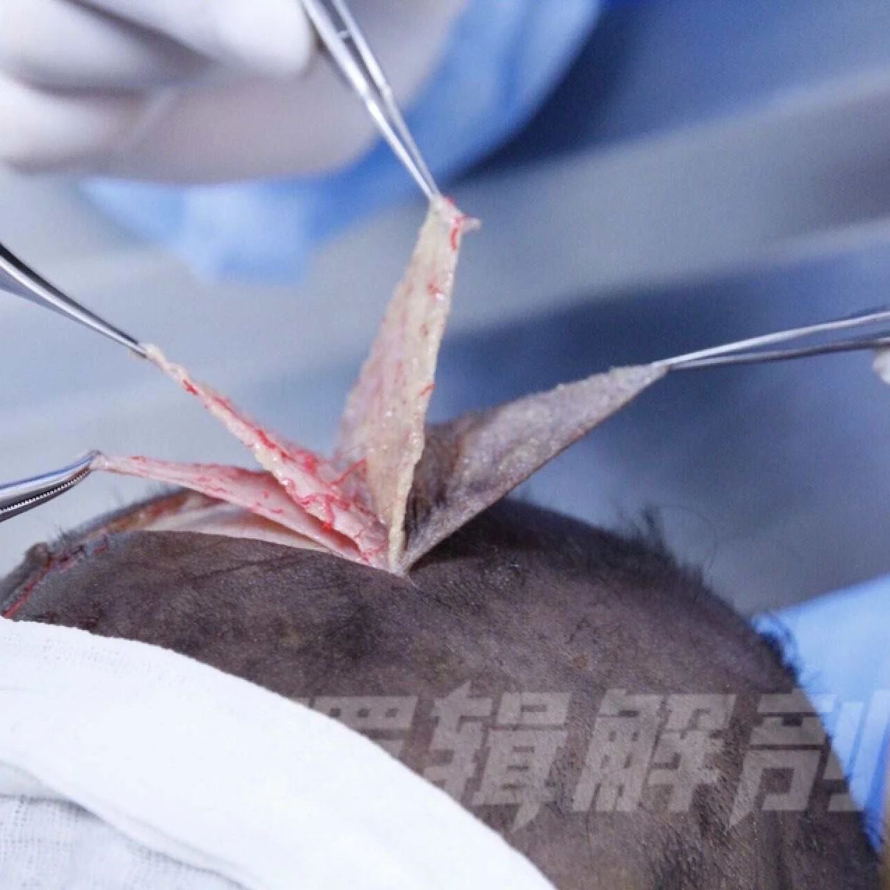 学习注射，为什么建议先从打额头开始？